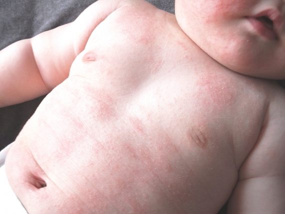赤ちゃんの乳児湿疹